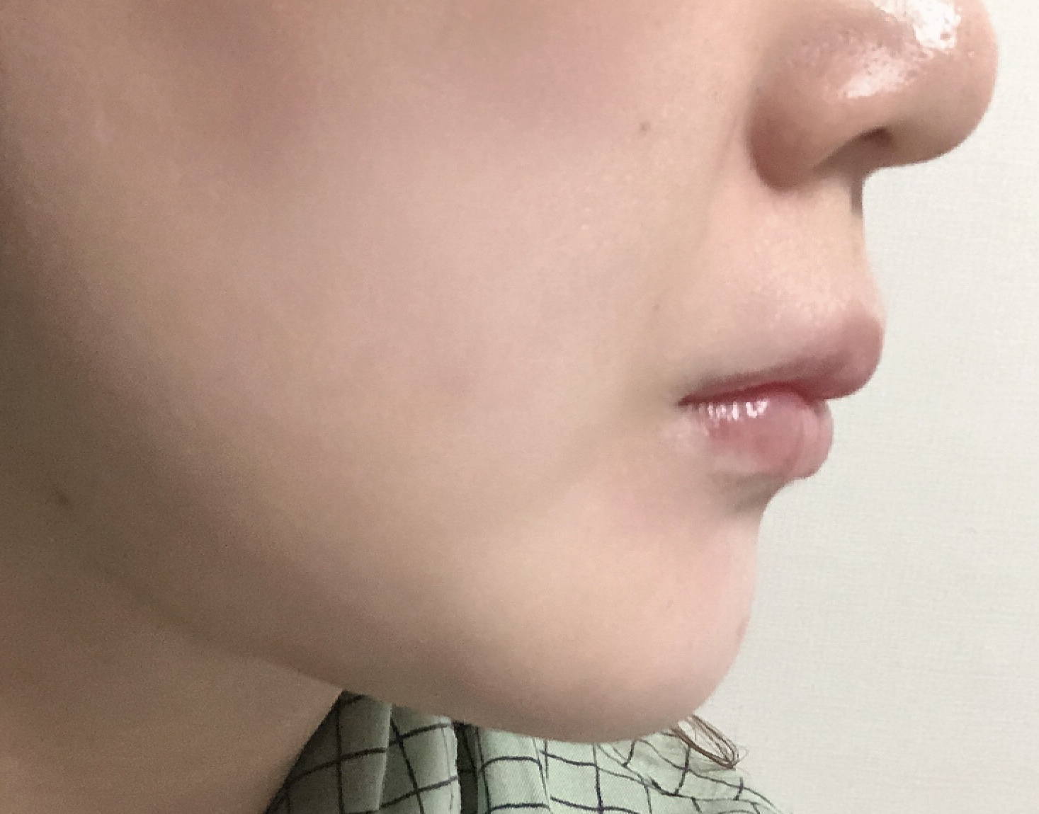 얼굴지흡 1달차!요즘 거울볼때마다 좋네요