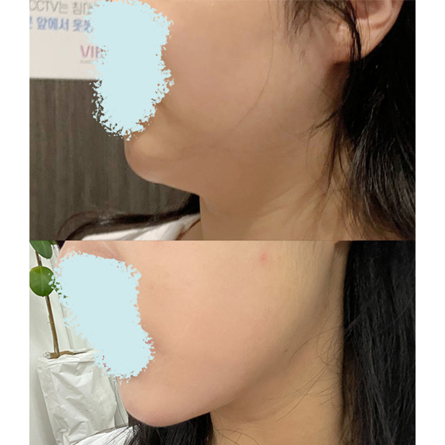 투턱없어져서 자신감 뿜뿜~~~