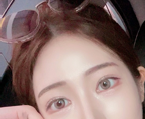 절개쌍꺼풀재수술, 이마거상 3개월됐어요:)