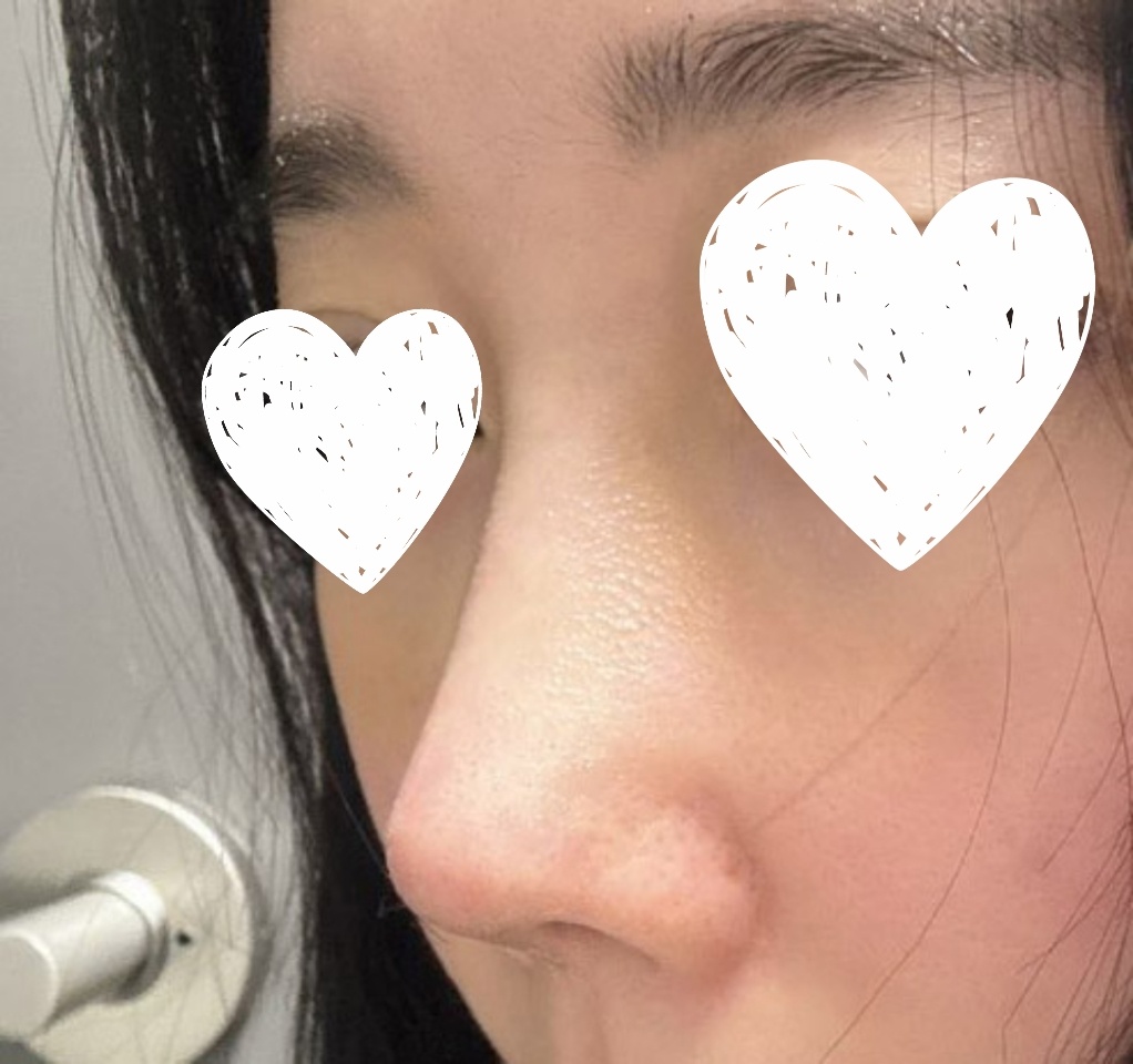 코재수술 잘돼서 후기써요~