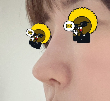 코수술 후 휘어서 바이브에서 재수술했습니다