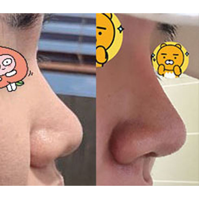 바이브 코성형후기!주변에서도 잘됐대요:)