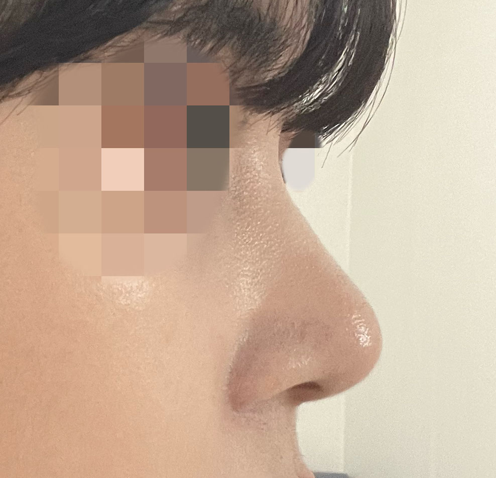 원하는 모양으로 잡아주셨어요(코수술4개월차)
