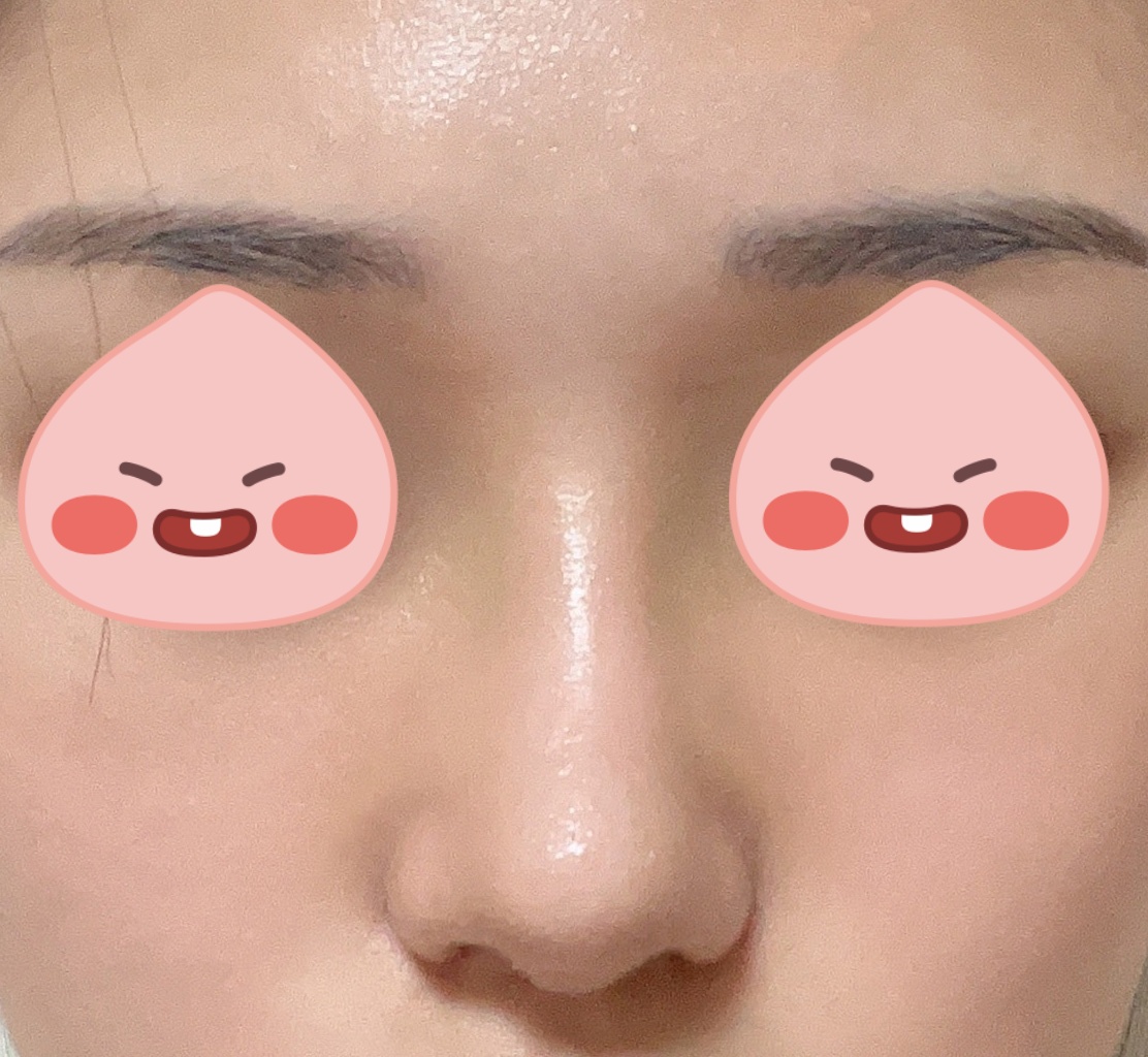 바이브에서 눈성형, 코성형한지 4개월차 지나갑니당