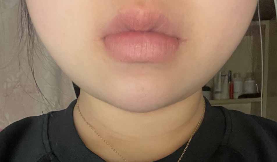 얼굴지방흡입과 턱필러 했습니당