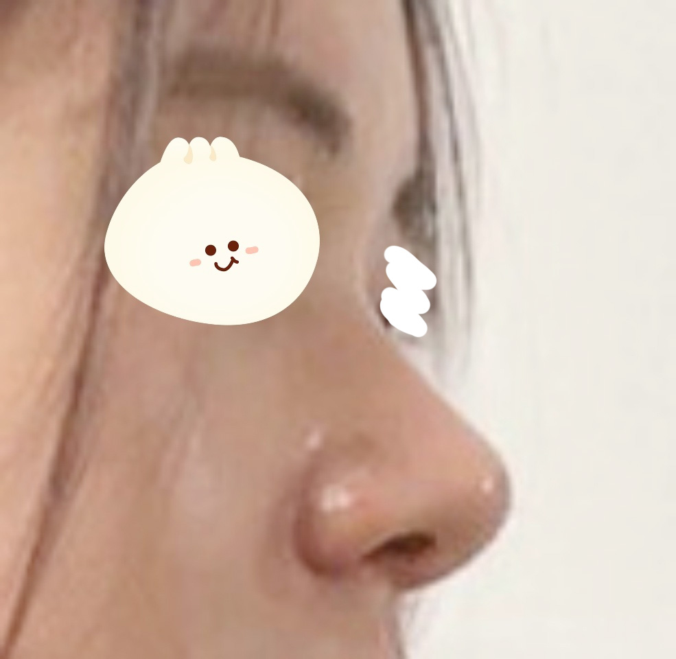 후기보고 매부리코수술했는데 만족백퍼센트ㅠ!!