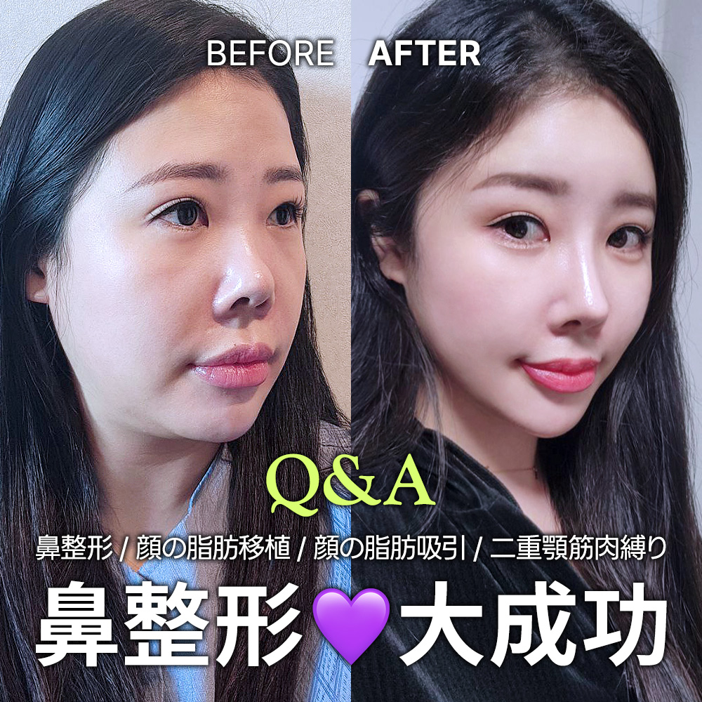 【韓国整形】鼻フル/脂肪注入/脂肪吸引/筋肉縛り★ダウンタイムVLOG