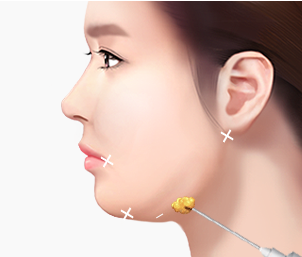 심부볼지방제거 Step 02