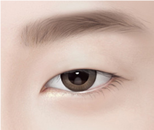 쌍꺼풀 수술 Step 01