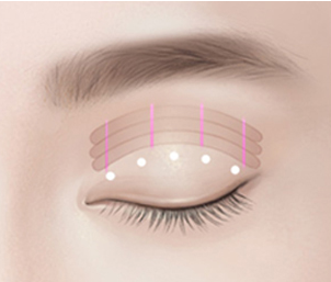 쌍꺼풀 수술 Step 02