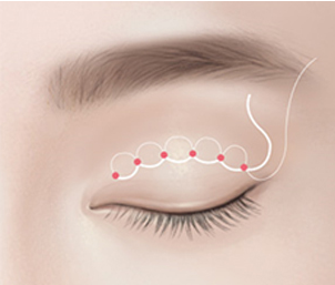 쌍꺼풀 수술 Step 03