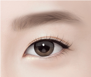 쌍꺼풀 수술 Step 04