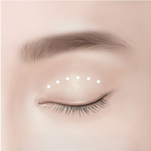 비절개 눈매교정