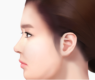 절개리프팅 Step 01