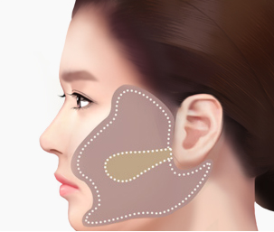 절개리프팅 Step 02