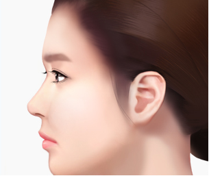 절개리프팅 Step 04