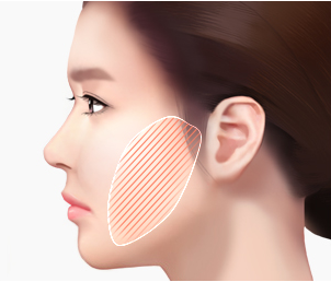 미니리프팅 Step 02