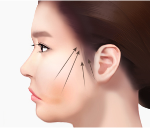 미니리프팅 Step 03