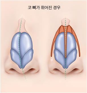 휜코 수술 Step 02