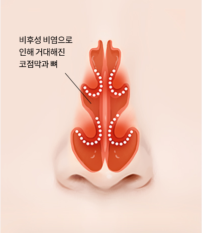비후성 비염