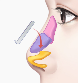 들창코 수술 Step 02