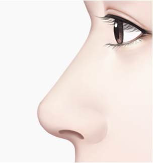 들창코 수술 Step 04